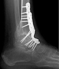 arthrodèse de cheville 2