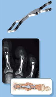 traitement arthrodèse inter-phalengienne 2