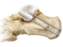 traitement arthrodese sub-talienne