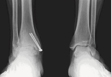 Arthrose de cheville : traitement et opération