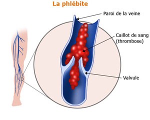 Complication phlébite