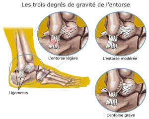 degrés de gravité entorse cheville