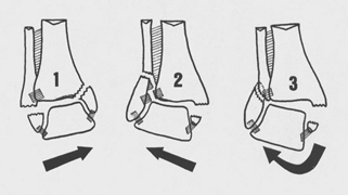 fracture uni ou bi malléolaire