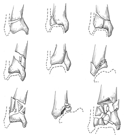 fracture du pilon tibial