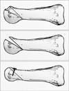 Ostéotomie du métatarsien