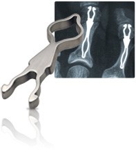 arthrodèse IP avec implant