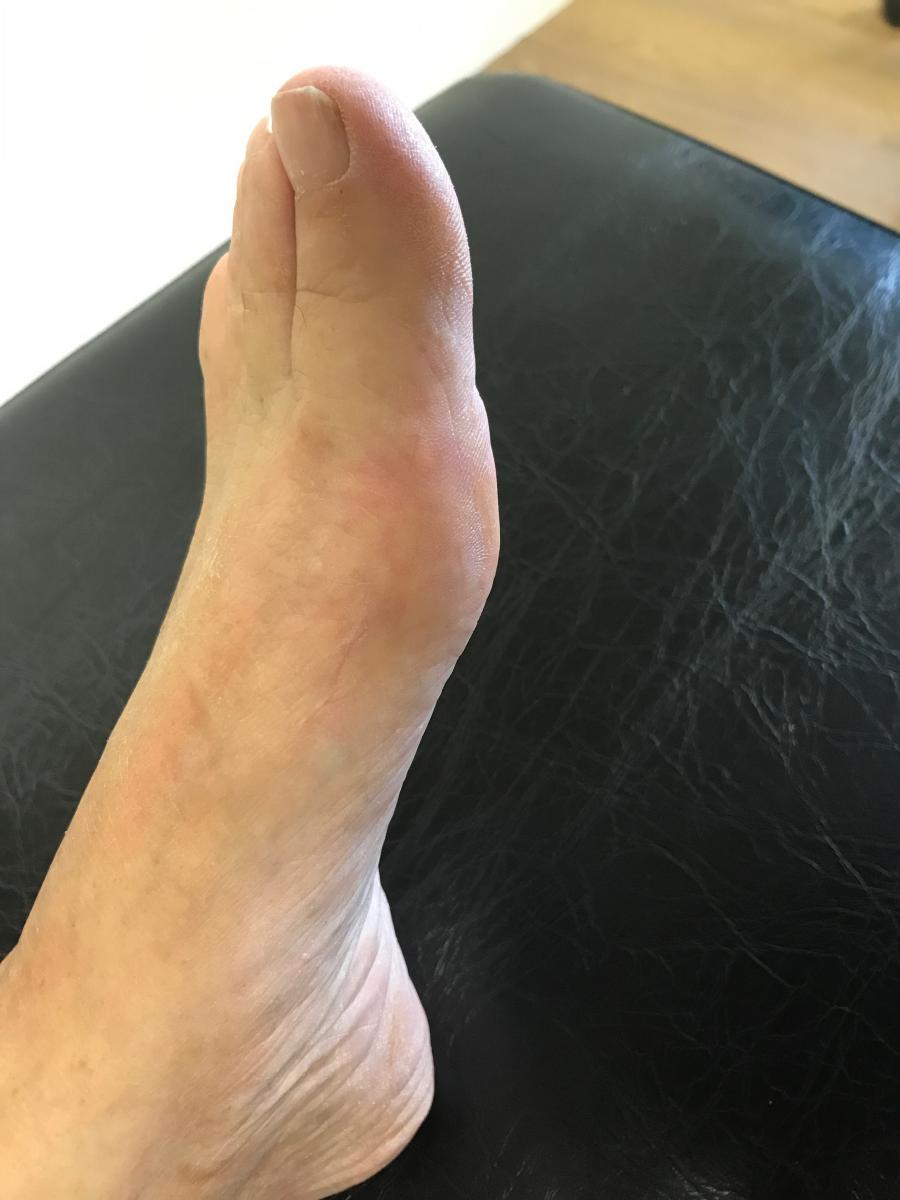 Résultat après opération d'un hallux Valgus