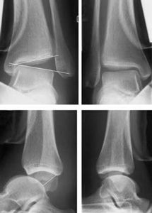 La cheville, articulation complexe, est sujette à diverses instabilités  parfois chroniques, non ligamentaires, qu'il faut diagnostiquer et dont le  traitement ne sera pas de réparer les ligaments - chirurgie pied cheville 