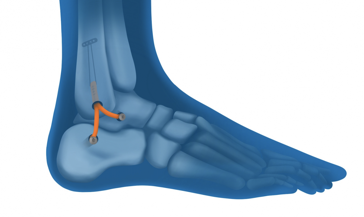 Entorses de la cheville, pathologie et intervention chirurgicale