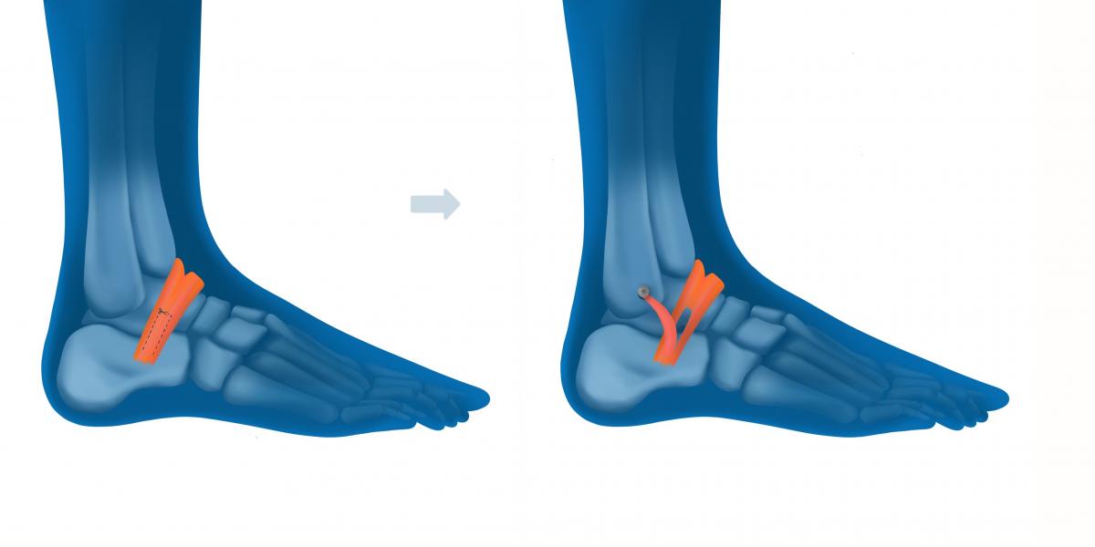 Ligamentoplastie de cheville à Lyon