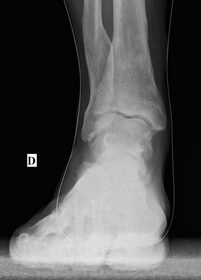 ostéotomie sur valgus d'arrière pied sur cal vicieux du tibia