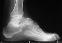 radiographie pied creux