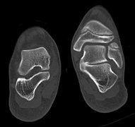 synostose pied gauche