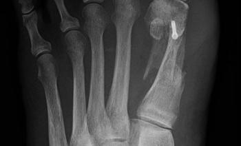 La ligamentoplastie dans l'hallux valgus