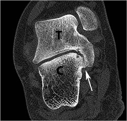 Synostose calcaneo- talienne 2