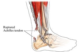 rupture tendon d'achille