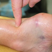 rupture tendon d'achille