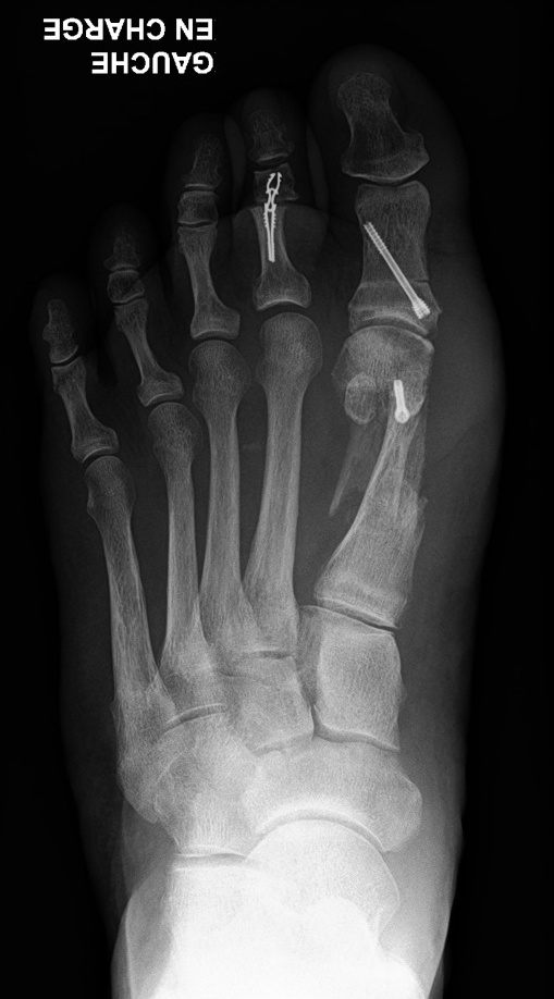 Photo avant/après correction d'un hallux valgus par chirurgie